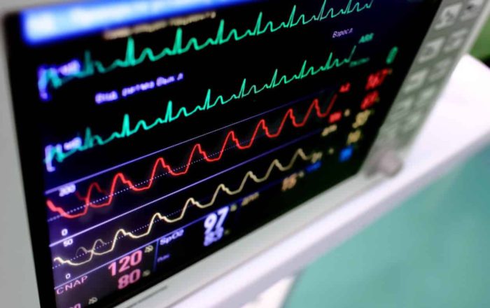 ECG Rhythm Recognition by Deep Convolutional Neural Network